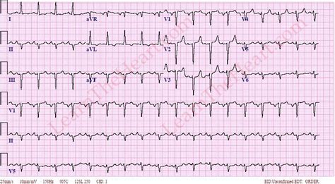 borderline ecg meaning|borderline ecg left atrial enlargement.